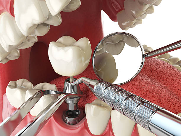 Best Emergency Dental Extractions in Highland, IN